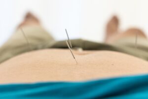 Closeup of acupuncture needles on belly of Chinese man during acupuncture treatment